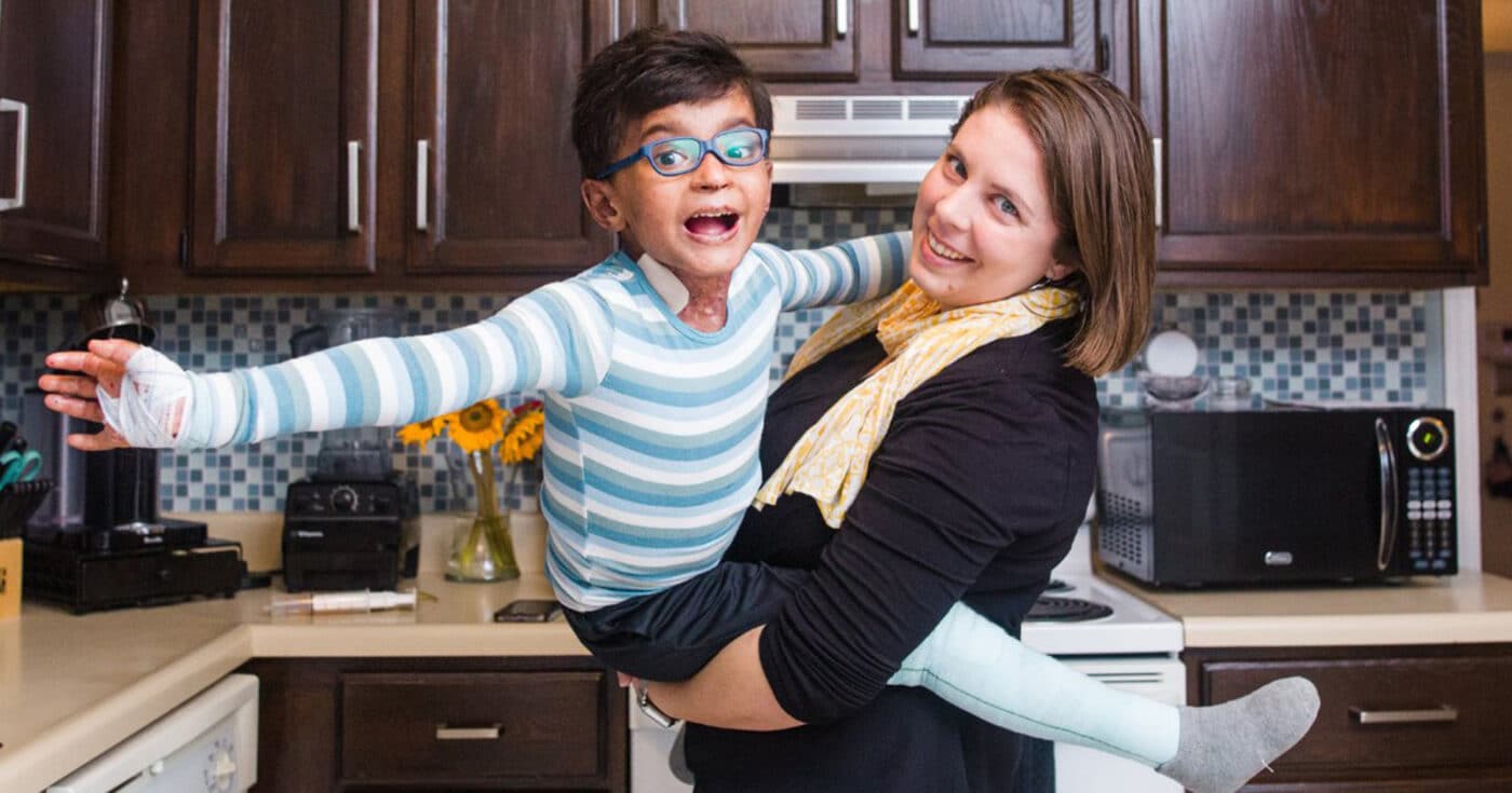 A woman holds a child an excited child with Epidermolysis Bullosa.
